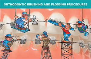 (Item # 440-213) Orthodontic Brushing and Flossing Procedures with Damon Brackets - Packs of 100